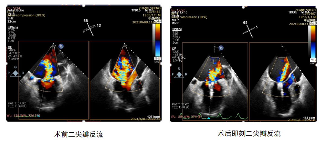 世界首例王春生魏来教授团队成功实施功能性二尖瓣反流经心尖缘对缘